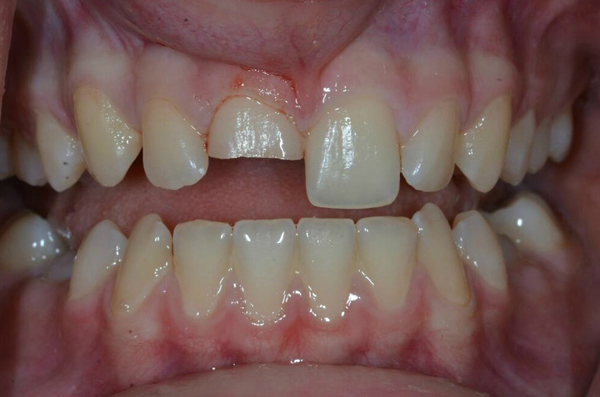 Before